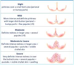 Image result for diaper dermatitis