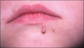 Image result for verrucae filiformes