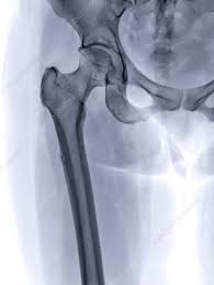 Image result for Hip XRay
