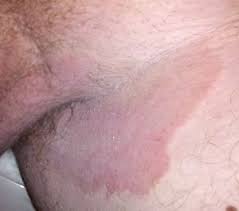 He's asking me to massage the duct connecting to my testicles. Tinea Cruris Wikipedia