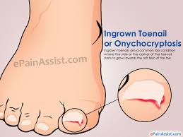 ingrown toenail treatment home