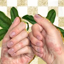 Recognizing psa in the early stages can help a person get treatment to manage symptoms and slow the progress of the condition. Do I Have Psoriatic Arthritis What Symptoms To Look For Allure