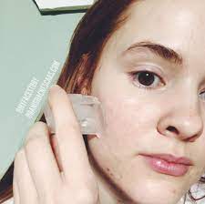 How To Prevent Acne Scars