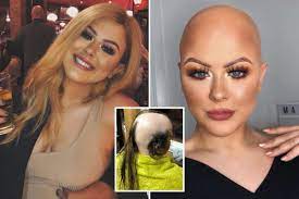Make Up Artist Who Was Diagnosed With Alopecia At 16 And Tried To Cover Her Bald Spots With Dry Shampoo Is Now Proud Of Her Look Hair Loss Scalp Treatment Bald Hair