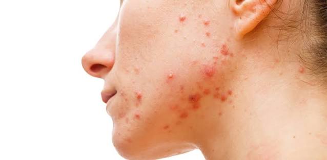 Cyst Pimple Treatment & Understanding: Causes, Symptoms, and Remedies