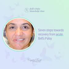 Seven Steps Towards Recovery From Acute Bell S Palsy Crystal Touch Bell S Palsy Clinic