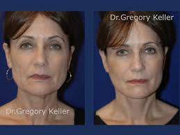 Santa Barbara Neck Lift Surgery