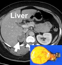 X Rays Ct Scans Mri And Other Tests For Adrenal Glands