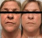 Morpheus8 Cost Uk - Morpheus8 Treatment Before and After