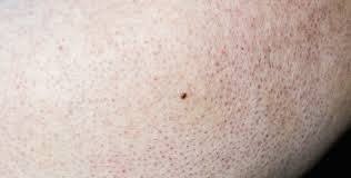 Image result for Keratosis pilaris