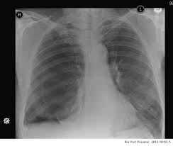 Most tumors arise from the pleura, and so this article will focus on pleural mesothelioma. Malignant Pleural Mesothelioma Presenting With A Spontaneous Hydropneumothorax A Report Of 2 Cases Pulmonology