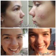 Any recommendations for pimples and under bumps