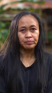 My cystic acne became a 'monster' when I turned 20