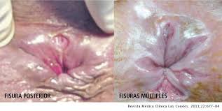 El diagnóstico de la trombosis hemorroidal externa es muy sencillo en la consulta con el médico es muy sencillo y puede realizarse con una inspección directa de la zona por parte del especialista. Urgencias Proctologicas Revista Medica Clinica Las Condes