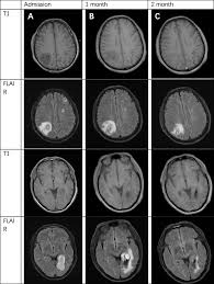 Image result for Brain Abscess