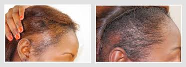 The doctor will determine the cause of hair loss and prescribe supplements to stop it. African American Hair Transplants Hair Restoration Center