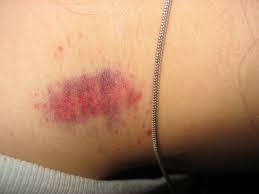 How To Get Rid Of A Hickey: Tips And Tricks - Bellatory
