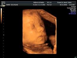 Grund für das verbot des 3d und 4d ultraschalls in der schwangerschaft ist die neue strahlenschutzverordnung, die anfang des jahres in kraft getreten ist. 3d Ultraschall In Der 26 Ssw Baby Youtube