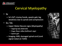 The hoffman's sign can be a useful test to help determine if a person has an upper motor neuron here is a video of the hoffman's sign performed in slow motion on a patient with severe central. Nw Surgical Research Foundation Conference Ppt Download