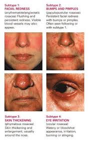 Entdecke rezepte, einrichtungsideen, stilinterpretationen und andere ideen zum ausprobieren. All About Rosacea Rosacea Treatment Acne Rosacea Rosacea Skin Care
