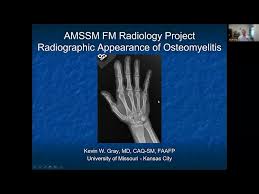 Image result for Osteomyelitis XRay