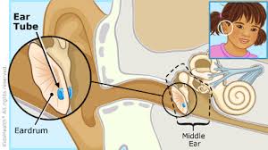 After swimming, dry your child's ears by wiping the outer ears gently with a soft towel or use a hair dryer. Ear Tube Surgery For Parents Nemours Kidshealth