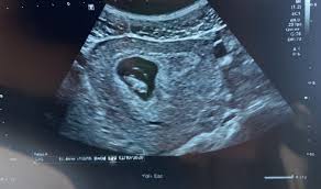 This is sometimes called a nuchal translucency scan. Updated Dating Scan After Lfhr October 2020 Birth Club Babycenter Australia