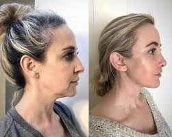 Deep Plane Facelift Before & After