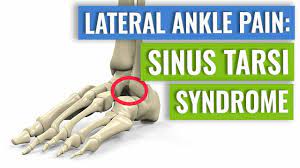 Sinus Tarsi Syndrome One Cause Of Lateral Ankle Pain Youtube