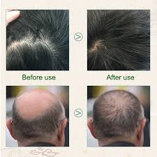 Other options include light therapy, hormone therapy, or in some cases, hair transplants. Men Women Hair Loss Treatment Hair Regrowth Treatment Tonic Cream Or88 Hair Loss Products Aliexpress