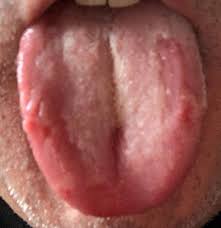How does covid tongue manifest? Here S How To Spot Covid Tongue A Symptom Of Coronavirus Related To The New Strain Yorkshirelive