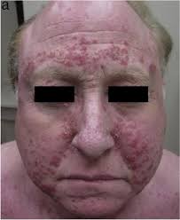 Grouped crusty inflammatory papules distributed symmetrically