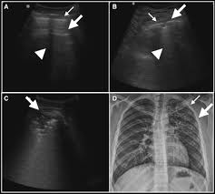 Tuberculosis is an infectious disease that causes inflammation, the formation of tubercles and other growths within tissue, and can cause tissue death. Lung Ultrasound Findings Compared With Chest X Ray Findings In Known Pulmonary Tuberculosis Patients A Cross Sectional Study In Lima Peru In The American Journal Of Tropical Medicine And Hygiene Volume 103 Issue 5