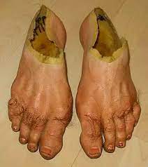 Uñas largas de los pies con hongos. Si Te Parecen Asquerosos Los Pies Estas 22 Imagenes Te Haran Vomitar Increible