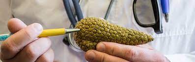 Pankreopriven Diabetes Erkennen Behandeln Diabetes Help