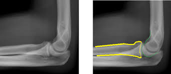Image result for Radial Head Dislocation