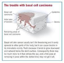 The characteristics and location of basal cell carcinoma vary somewhat with the type, although many are a mixture of types. Basal Cell Carcinoma Overview Harvard Health