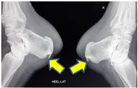 Adrenocortical carcinoma associated with adrenogenital syndrome in a child. Cureus Mulholland Deformity With Pump Bump