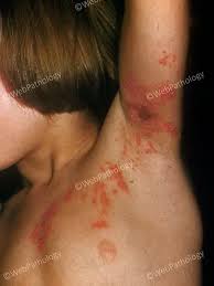 Image result for herpes zoster