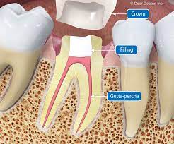 More images for root canal care after procedure » Root Canal Treatment What You Need To Know