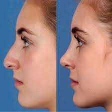 Typically, the doctor makes one long incision in your hip to remove the bone and. What Is Plastic Surgery American Society Of Plastic Surgeons