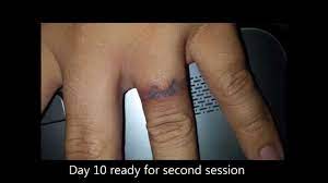 Our pricing has always been published online, too. 1st Week Tattoo Removal Healed Up Youtube