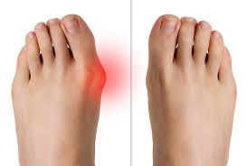 Surgery for bunions is only very rarely needed, and some studies have found that after surgery up to 35 percent of patients report being unsatisfied with the outcome of the. How To Correct Bunions Without Surgery In Dallas Plano