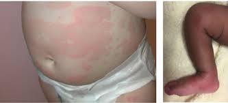 Identify and expunge provoking agent. Hives Urticaria In Children Healthychildren Org