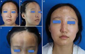 Photos of the patient's face before and after treatment. (A–C)...