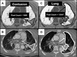 Image result for Pulmonary Contusion