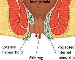 Image result for itchy skin rectum