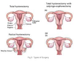 We weren't sure our family was complete and were hoping for another baby when i was told that i would need a hysterectomy. Cervical Cancer Treatment Hysterectomy Chemotherapy And Radiotherapy Doctor Kkh