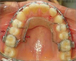 Byrne orthodontics has offices in saratoga springs & greenwich, ny. Distal Driving Of Molar By Smart Distal Propeller Appliance Apos Trends In Orthodontics