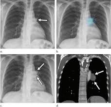 Image result for lung cancer xray